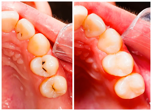 dental sealants example
