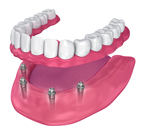 dentures example